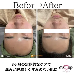 Meupニキビ専門店 背中/ハーブ/肌管理のその他イメージ