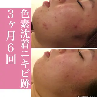 ニキビ特化型エステ 🍓最短で肌質改善のエステ・リラクイメージ