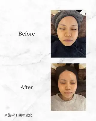 ハーブピーリング🌿 REVI/Ayanoのエステ・リラクイメージ