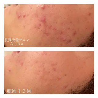 ショート カラー パーマ ヘアアレンジ メンズ キッズ ネイル マツエク・マツパ ニキビ跡専門サロン Ainaのエステ・リラクイメージ