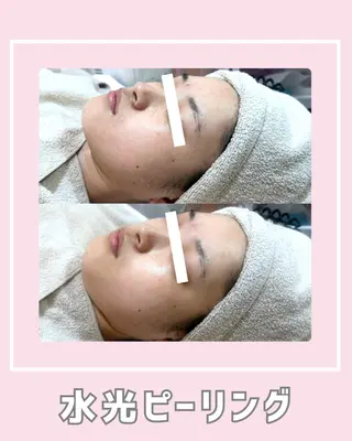 |ピーリング・毛穴| soina神楽坂のエステ・リラクイメージ