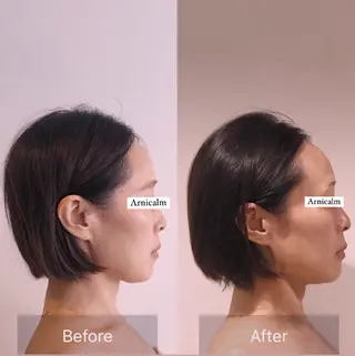 ハーブピーリング 肌再生ピーリング/のエステ・リラクイメージ