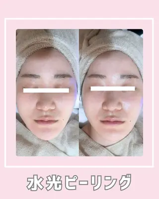 |ピーリング・毛穴| soina神楽坂のエステ・リラクイメージ