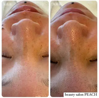 beauty salon PEACH所属・毛穴ケア/肌質改善 🫧ツヤ肌誕生🪄のエステ・リラクイメージ