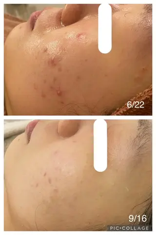 セミロング カラー パーマ ヘアアレンジ メンズ キッズ ネイル マツエク・マツパ アイブロウ 🔥3か月で肌革命 🔥ニキビ専門店のエステ・リラクイメージ