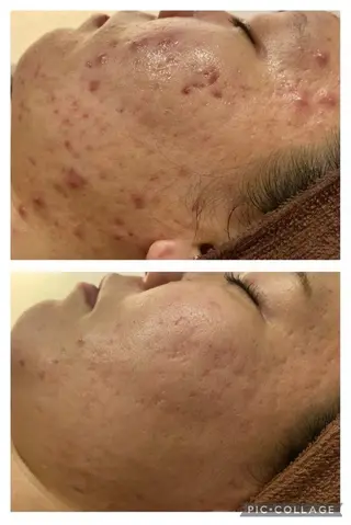 ロング カラー パーマ ヘアアレンジ メンズ キッズ ネイル マツエク・マツパ アイブロウ ニキビ特化型エステ 🍓最短で肌質改善のエステ・リラクイメージ