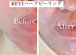 🌿ハーブピーリング ・脱毛◆Refreのエステ・リラクイメージ