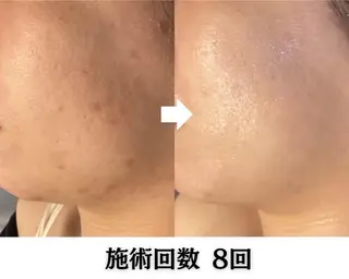 池袋毛穴ニキビ改善 ハーブピーリングのエステ・リラクイメージ