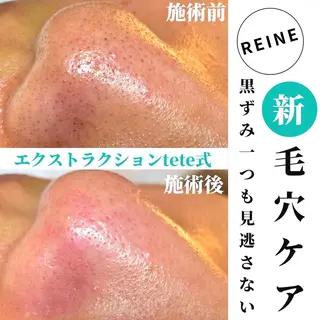 Reine BeautySalon所属・毛穴/シミ肝斑/脱毛 横山梨里のエステ・リラクイメージ
