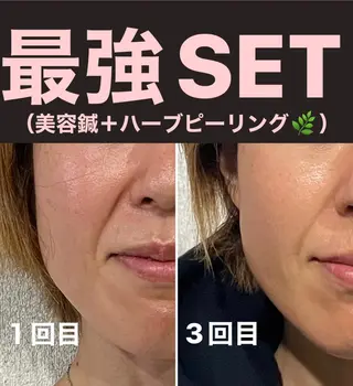 つばさ所属・マッツンの 鍼のその他イメージ