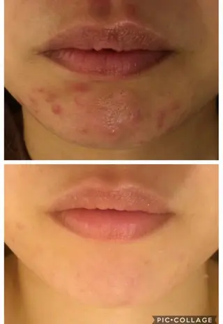 セミロング カラー パーマ ヘアアレンジ メンズ キッズ ネイル マツエク・マツパ アイブロウ 肌質体質を変えて すっぴん肌にのエステ・リラクイメージ