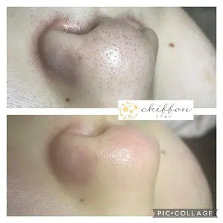 毛穴黒ずみ改善🥇 ✨シフォン豊田✨のエステ・リラクイメージ