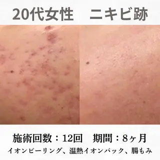 重度ニキビ専門🌷 ダウンタイムなしのエステ・リラクイメージ