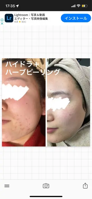 ロング ハーブピーリング専門 🌿モッカのエステ・リラクイメージ