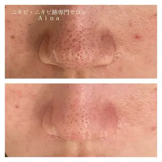 ニキビ跡専門サロン Ａｉｎａのエステ・リラクイメージ
