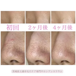 毛穴ケア専門サロンアンスリウム所属・茨城土浦 つくば毛穴 ケア専門サロンのエステ・リラクイメージ