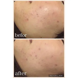 ニキビ跡専門サロン Ａｉｎａのエステ・リラクイメージ