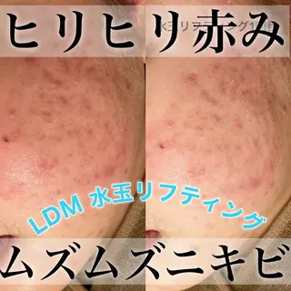 【ニキビ/肌管理】 salon varyのエステ・リラクイメージ