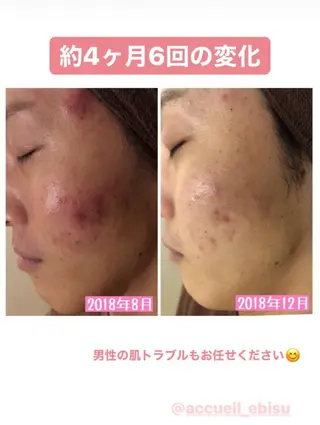 ミディアム カラー パーマ ヘアアレンジ メンズ キッズ ネイル マツエク・マツパ ニキビ・肌質改善専門 ♡人生が変わるサロンのエステ・リラクイメージ