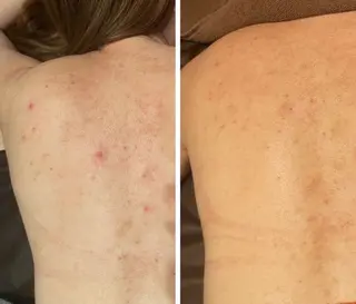 ハーブピーリング re:proのエステ・リラクイメージ