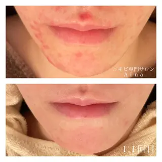 ミディアム カラー パーマ ヘアアレンジ メンズ キッズ ネイル マツエク・マツパ ニキビ跡専門サロン Ainaのエステ・リラクイメージ