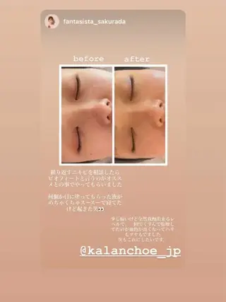 肌質改善 KALANCHOEのエステ・リラクイメージ