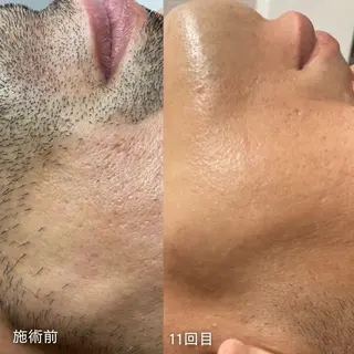 脱毛 Beauty salon Lumiere(ルミエール)所属・完全都度払い脱毛⭐︎ Lumiereのエステ・リラクイメージ