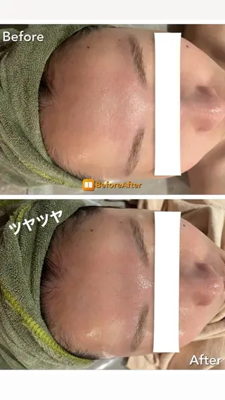 Meupニキビ専門店 背中/ハーブ/肌管理のその他イメージ