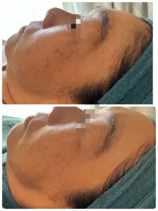 【リベルハーブピーリング認定店】敏感肌・美白脱毛専門店Dione立川店所属・Dione 立川店のエステ・リラクイメージ