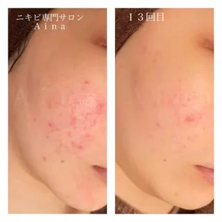 ミディアム カラー パーマ ヘアアレンジ メンズ キッズ ネイル マツエク・マツパ ニキビ跡専門サロン Ａｉｎａのエステ・リラクイメージ