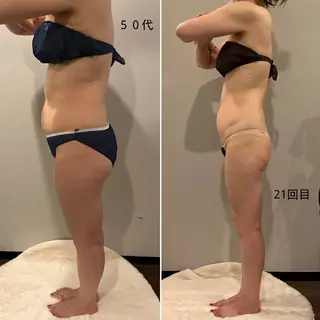 ✨痩身 ✨ハイパーナイフEXのエステ・リラクイメージ