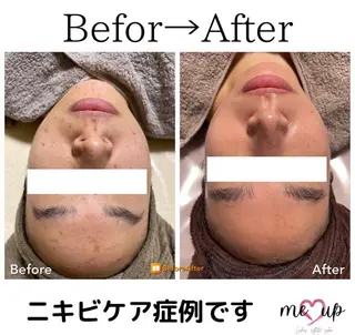 Meupニキビ専門店 背中/ハーブ/肌管理のその他イメージ
