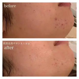 セミロング ヘアアレンジ キッズ ネイル マツエク・マツパ ニキビ跡専門サロン Ａｉｎａのエステ・リラクイメージ