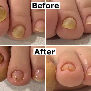 ネイル Mellow nail所属・巻爪無料モデル募集 ✨🦶MEGUMIのネイルデザイン