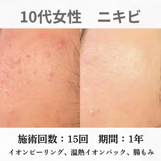 重度ニキビ専門🌷 ダウンタイムなしのエステ・リラクイメージ