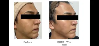 【赤ニキビ改善】 BELL'ET新宿店のエステ・リラクイメージ