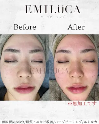 ハーブピーリング専門EMILUCA藤沢所属・ハーブピーリング /KAEDEのエステ・リラクイメージ