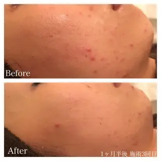 セミロング カラー パーマ ネイル マツエク・マツパ ニキビ跡専門サロン Ａｉｎａのエステ・リラクイメージ