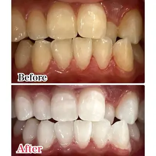 メンズ プラチナムビューティー柏所属・【歯科提携】柏ホワイ トニングスタイルのその他イメージ