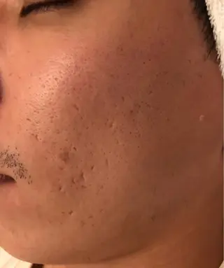 ニキビ専門サロン ド　ミモザのエステ・リラクイメージ