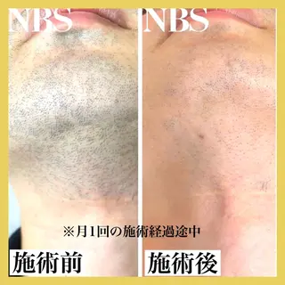 メンズ epismoo 脱毛/HBL/毛穴の眉毛・アイブロウイメージ