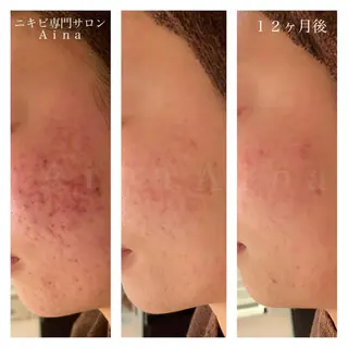 セミロング カラー パーマ ヘアアレンジ メンズ キッズ ネイル マツエク・マツパ ニキビ跡専門サロン Ａｉｎａのエステ・リラクイメージ