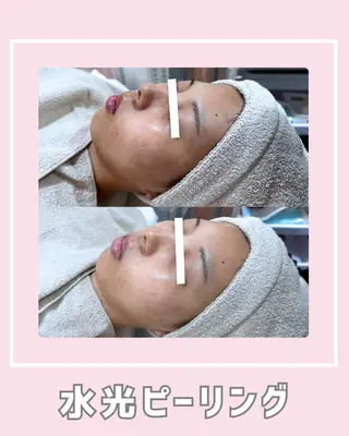 |ピーリング・毛穴| soina神楽坂のエステ・リラクイメージ