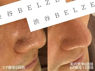 渋谷ベルゼ🌷木下 毛穴/脱毛/フェムのその他イメージ