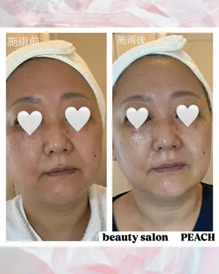 beauty salon PEACH所属・毛穴ケア/肌質改善 🫧ツヤ肌誕生🪄のエステ・リラクイメージ