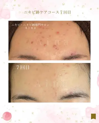 ニキビ跡専門サロン Ａｉｎａのエステ・リラクイメージ