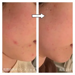 ショート パーマ ヘアアレンジ キッズ ネイル マツエク・マツパ ニキビ跡専門サロン Ａｉｎａのエステ・リラクイメージ