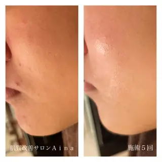 ショート カラー パーマ ヘアアレンジ メンズ キッズ ネイル マツエク・マツパ ニキビ跡専門サロン Ainaのエステ・リラクイメージ