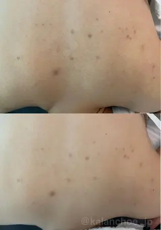 肌質改善 KALANCHOEのエステ・リラクイメージ