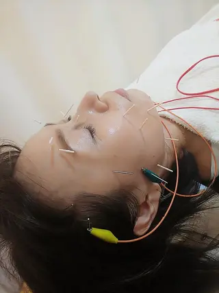 リフトアップ・たるみ ☆美容鍼小顔矯正のその他イメージ